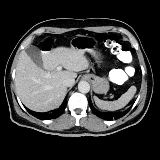File:Acute appendicitis (Radiopaedia 77016-88960 Axial C+ portal venous phase 32).jpg