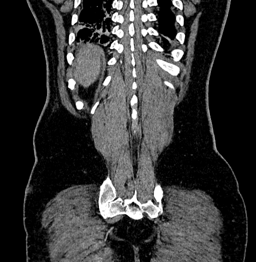 Acute appendicitis (Radiopaedia 79950-93224 Coronal C+ portal venous phase 84).jpg