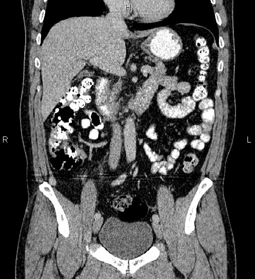 Acute appendicitis (Radiopaedia 84780-100240 Coronal C+ portal venous phase 36).jpg