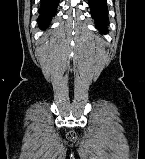 Acute appendicitis (Radiopaedia 84780-100240 Coronal C+ portal venous phase 77).jpg