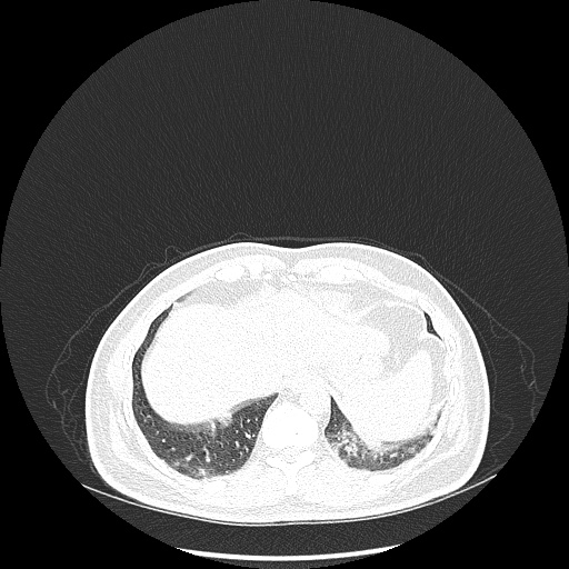 Acute appendicitis and COVID 19 pneumonia (Radiopaedia 76604-88380 Axial lung window 47).jpg