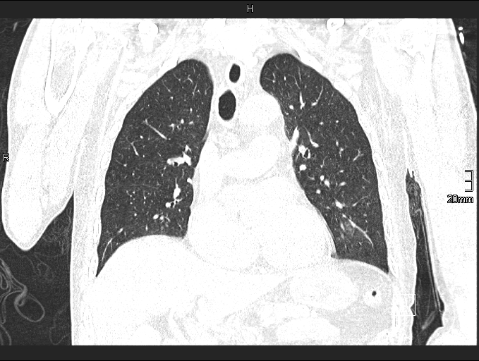 File:Acute aspiration pneumonitis (Radiopaedia 55642-62166 Coronal lung window 44).jpg