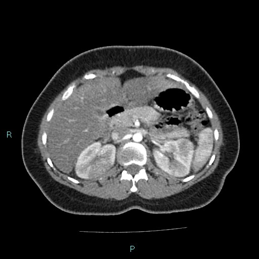 Acute bilateral pyelonephritis (Radiopaedia 37146-38881 Axial C+ arterial phase 63).jpg