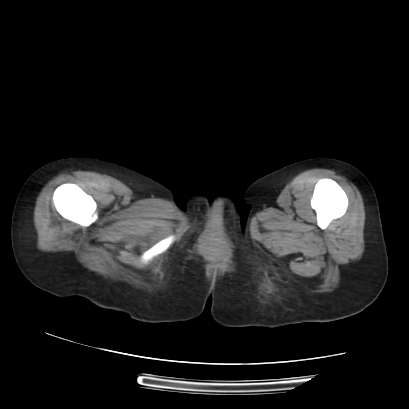 File:Acute calculous cholecystitis in patient with osteopetrosis (Radiopaedia 77871-90159 Axial non-contrast 87).jpg