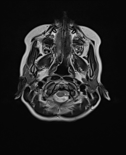 File:Acute cerebellar ataxia (Radiopaedia 61487-69446 Axial T2 1).jpg