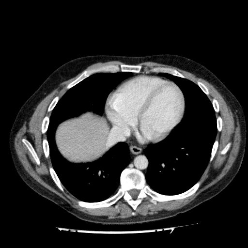 File:Acute cholecystitis and incidental left sided IVC (Radiopaedia 49352-54459 Axial C+ portal venous phase 19).jpg