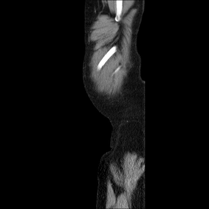 Acute cholecystitis and incidental left sided IVC (Radiopaedia 49352-54459 Sagittal C+ portal venous phase 6).jpg