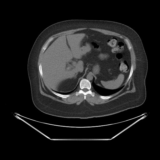 Acute cholecystitis with tensile fundus sign (Radiopaedia 71394-81723 Axial non-contrast 9).jpg