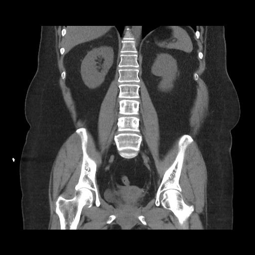 Acute cholecystitis with tensile fundus sign (Radiopaedia 71394-81723 Coronal non-contrast 81).jpg