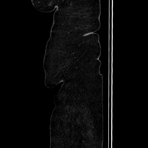 Acute diverticulitis - transverse colon (Radiopaedia 87063-103327 Sagittal C+ portal venous phase 34).jpg