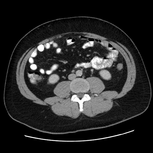 File:Acute diverticulitis with localized perforation (Radiopaedia 41296-44113 Axial C+ portal venous phase 50).jpg