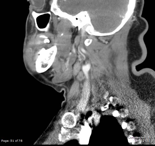 Acute epiglottitis (Radiopaedia 54375-60590 Sagittal C+ arterial phase 51).jpg