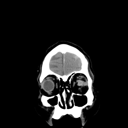 Acute hemorrhagic stroke (Radiopaedia 17507-17223 Coronal non-contrast 4).jpg