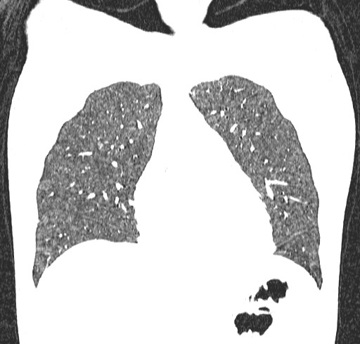 Acute hypersensitivity pneumonitis (Radiopaedia 85293-100870 Coronal lung window 33).jpg