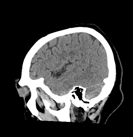 Acute internal carotid artery dissection (Radiopaedia 53541-59558 Sagittal non-contrast 13).jpg