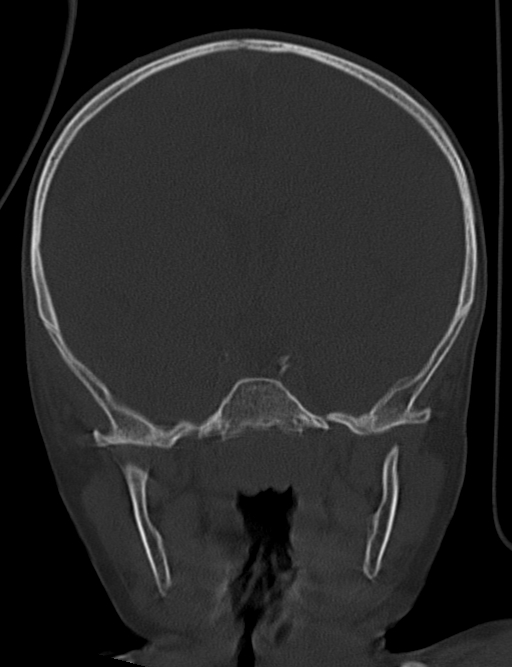 Acute mastoiditis (Radiopaedia 82678-96881 Coronal bone window 34).jpg