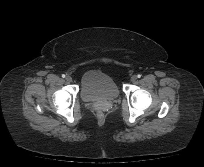 Acute mesenteric ischemia (Radiopaedia 80029-93316 Axial C+ arterial phase 129).jpg