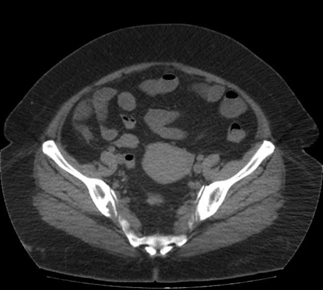 Acute mesenteric ischemia (Radiopaedia 80029-93316 Axial non-contrast 70).jpg