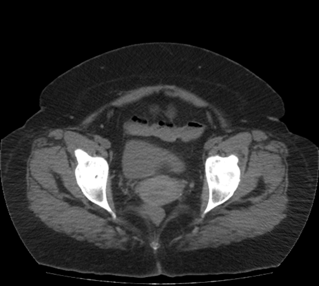 Acute mesenteric ischemia (Radiopaedia 80029-93316 Axial non-contrast 80).jpg