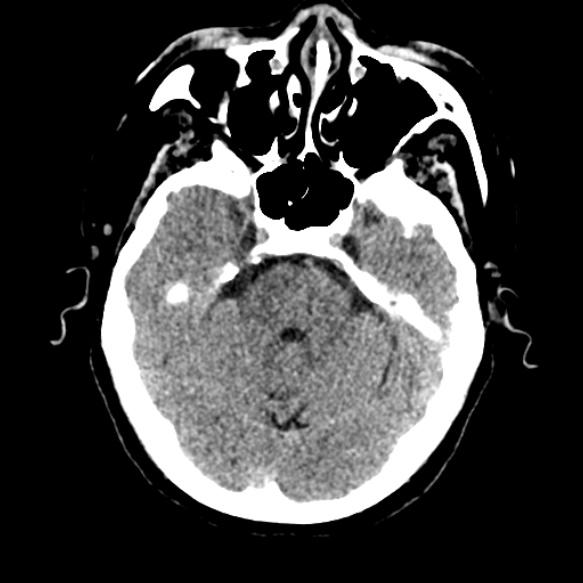 Acute middle cerebral artery territory infarct (Radiopaedia 52380-58283 Axial non-contrast 27).jpg