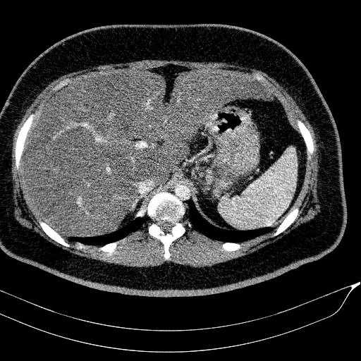 File:Acute on chronic pancreatitis (Radiopaedia 80902-94423 Axial C+ portal venous phase 38).jpg