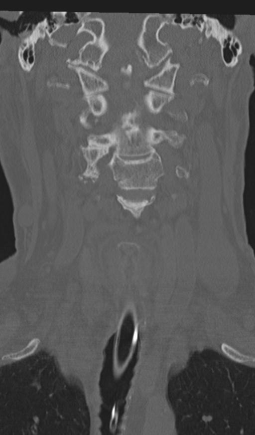 Acute on chronic subdural hematoma and thoracic vertebral injury in a multitrauma patient (Radiopaedia 31698-32619 Coronal bone window 18).jpg