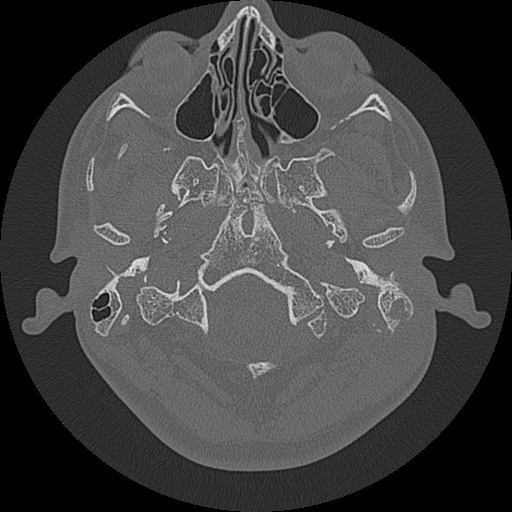 Acute otomastoiditis and Bezold abscess (Radiopaedia 88184-104786 Axial bone window 15).jpg
