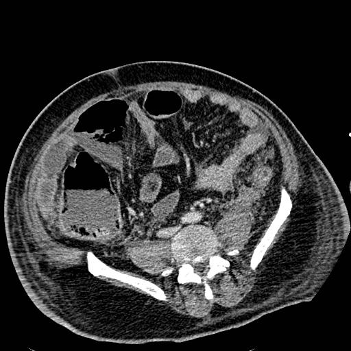 Acute pancreatic necrosis (Radiopaedia 13560-18501 Axial C+ portal venous phase 95).jpg