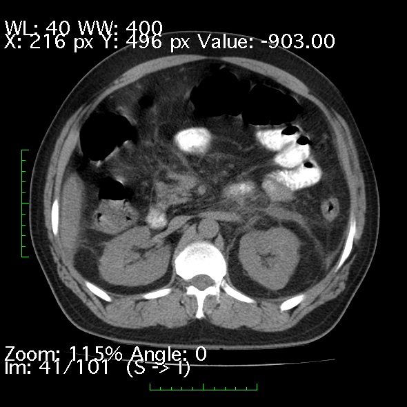 Acute pancreatitis (Radiopaedia 34043-35276 Axial non-contrast 41).jpg