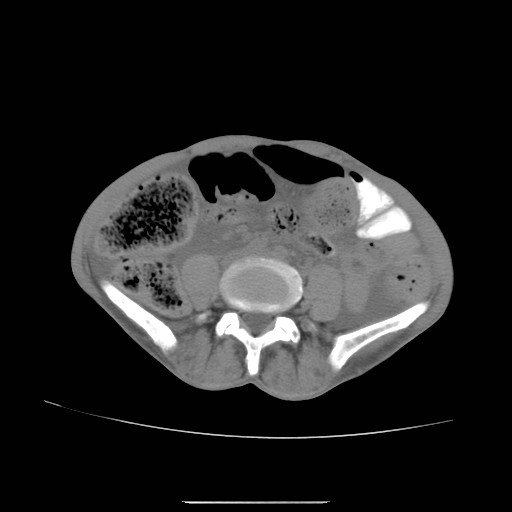 File:Acute pancreatitis (Radiopaedia 50213-55558 Axial non-contrast 31).jpg