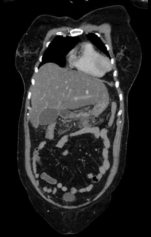 Acute pancreatitis (Radiopaedia 80007-93285 Coronal C+ portal venous phase 21).jpg