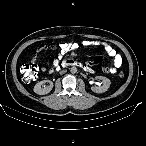 File:Acute pancreatitis (Radiopaedia 85390-101010 Axial C+ delayed 40).jpg