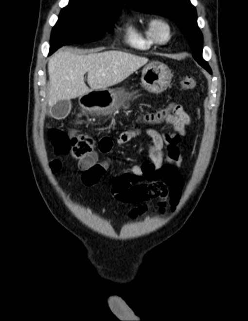 Acute pancreatitis - Balthazar E (Radiopaedia 23080-23110 Coronal C+ portal venous phase 13).jpg