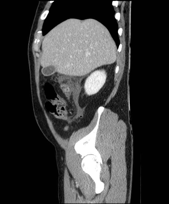Acute pancreatitis - Balthazar E (Radiopaedia 23080-23110 Sagittal C+ portal venous phase 16).jpg