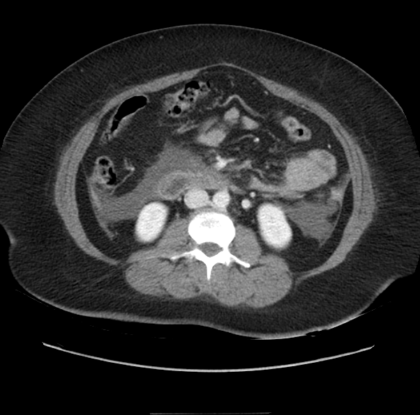 Acute pancreatitis - Balthazar E (Radiopaedia 29016-29377 Axial C+ portal venous phase 34).png