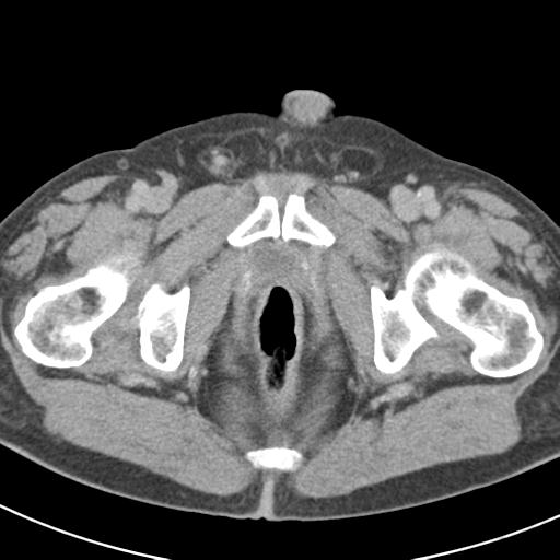 Acute pancreatitis and walled-off necrosis (Radiopaedia 29888-30403 Axial C+ delayed 83).jpg