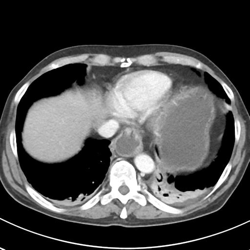 File:Acute pancreatitis and walled-off necrosis (Radiopaedia 29888-30404 Axial C+ portal venous phase 8).jpg