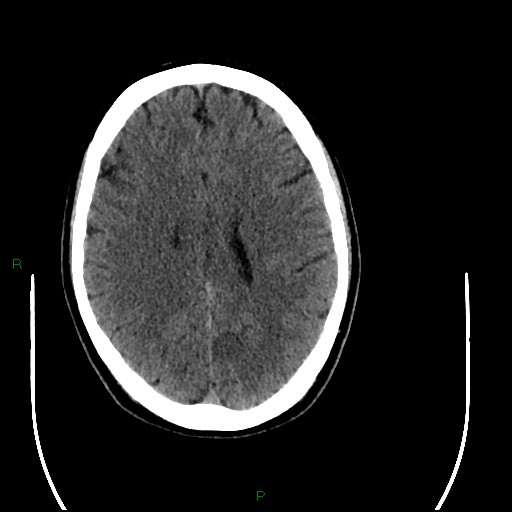 Acute posterior cerebral artery territory infarct (Radiopaedia 79329-92393 Axial non-contrast 70).jpg