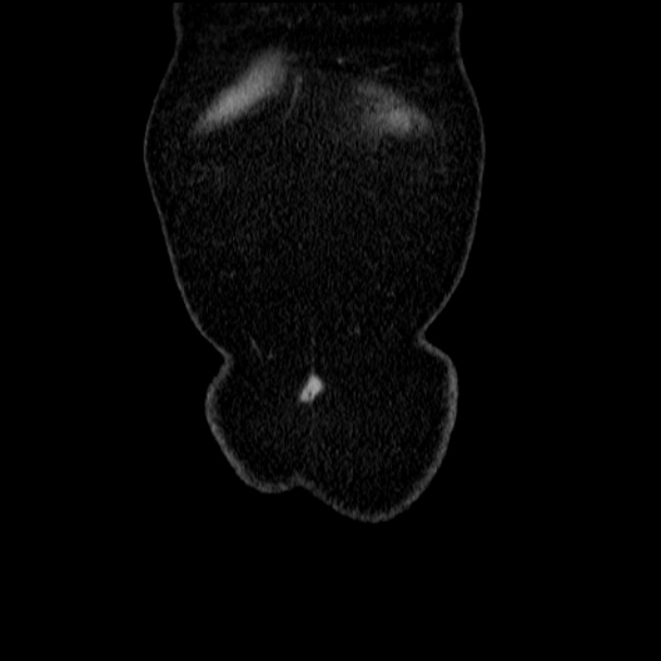 Acute pyelonephritis (Radiopaedia 33397-34434 Coronal renal parenchymal phase 10).jpg