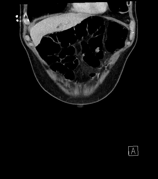 Acute renal infarction (Radiopaedia 59375-66736 Coronal C+ portal venous phase 14).jpg