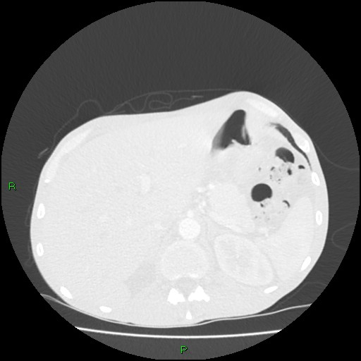 Acute right lung abscess (Radiopaedia 34806-36258 Axial lung window 185).jpg