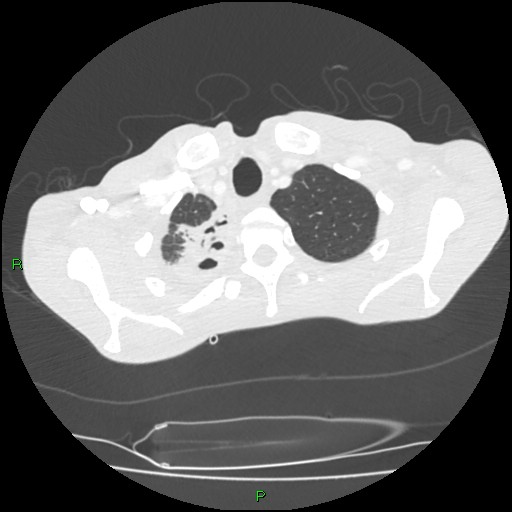Acute right lung abscess (Radiopaedia 34806-36258 Axial lung window 19).jpg