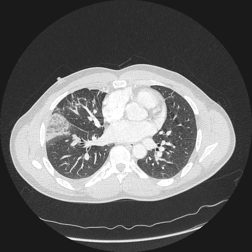 Acute segmental pulmonary emboli and pulmonary infarction (Radiopaedia 62264-70444 Axial lung window 107).jpg