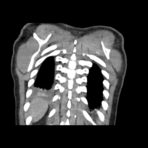 Acute segmental pulmonary emboli and pulmonary infarction (Radiopaedia 62264-70444 Coronal C+ CTPA 52).jpg