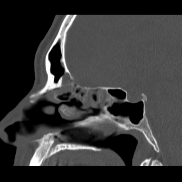 Acute sinusitis (Radiopaedia 23161-23215 Sagittal bone window 34).jpg