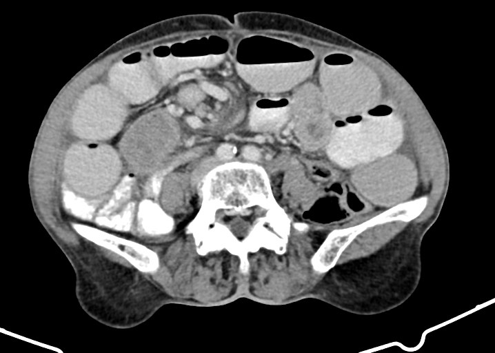Acute small bowel (ileal) volvulus (Radiopaedia 71740-82139 Axial C+ portal venous phase 127).jpg