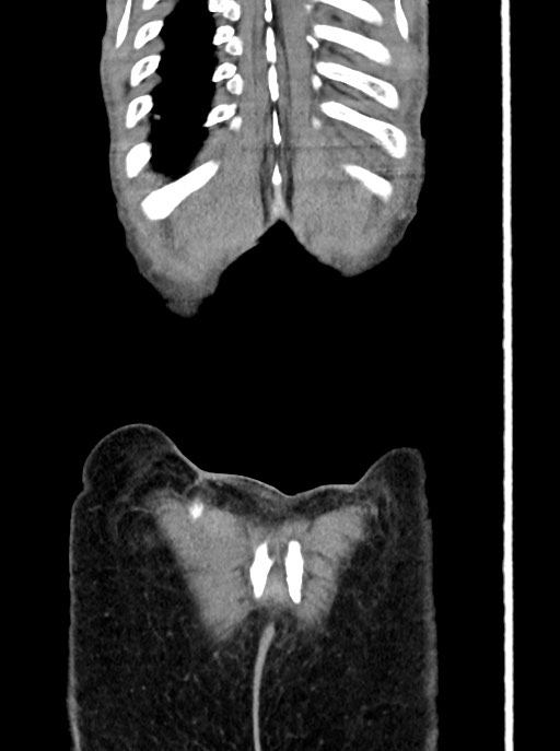 Acute small bowel (ileal) volvulus (Radiopaedia 71740-82139 Coronal C+ portal venous phase 107).jpg