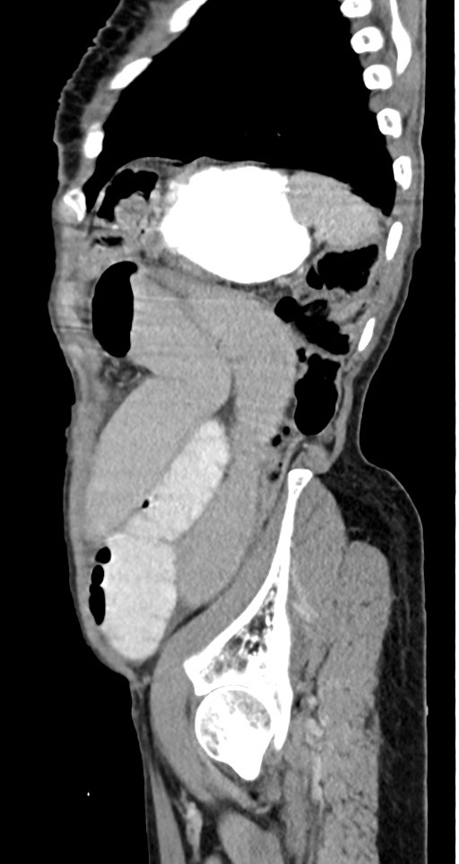 Acute small bowel (ileal) volvulus (Radiopaedia 71740-82139 Sagittal C+ portal venous phase 43).jpg