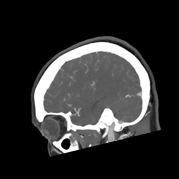 Acute subarachnoid hemorrhage and accessory anterior cerebral artery (Radiopaedia 69231-79009 Sagittal C+ arterial phase 53).jpg
