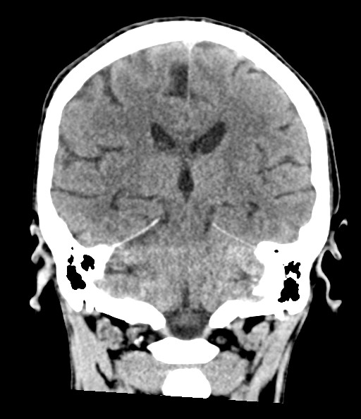 File:Acute superior cerebellar artery territory infarct (Radiopaedia 84104-99359 Coronal non-contrast 57).jpg